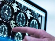 Estrés causado por desigualdad de género cambia la estructura del cerebro de las mujeres, según estudio