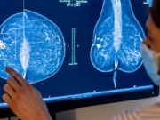 Las desigualdades de género empeoran el acceso de las mujeres a la prevención, detección y atención del cáncer