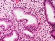 Un nuevo mapa del endometrio abre la puerta a encontrar posibles tratamientos a la endometriosis